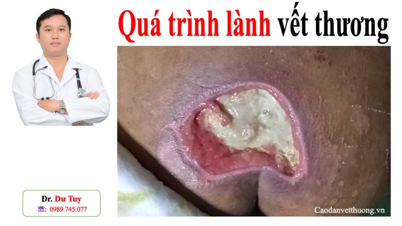 Hình ảnh vết thương bị nhiễm trùng