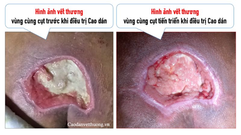 Hình ảnh vết thương bị nhiễm trùng