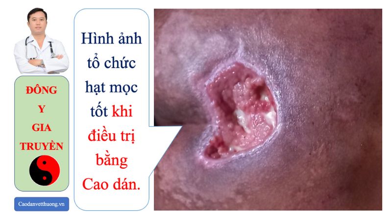 Hình ảnh vết thương bị nhiễm trùng