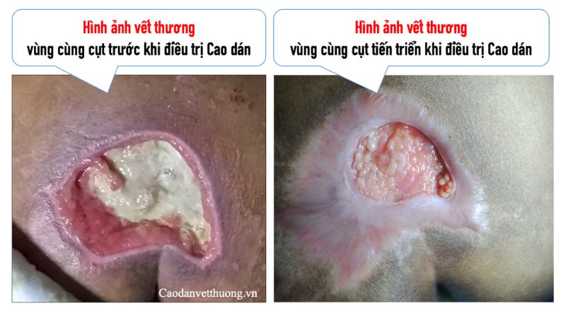 Hình ảnh vết thương bị nhiễm trùng