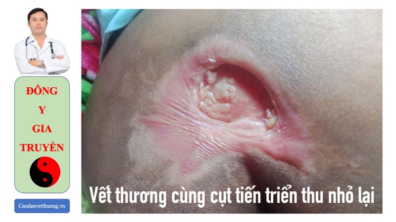 Hình ảnh vết thương bị nhiễm trùng