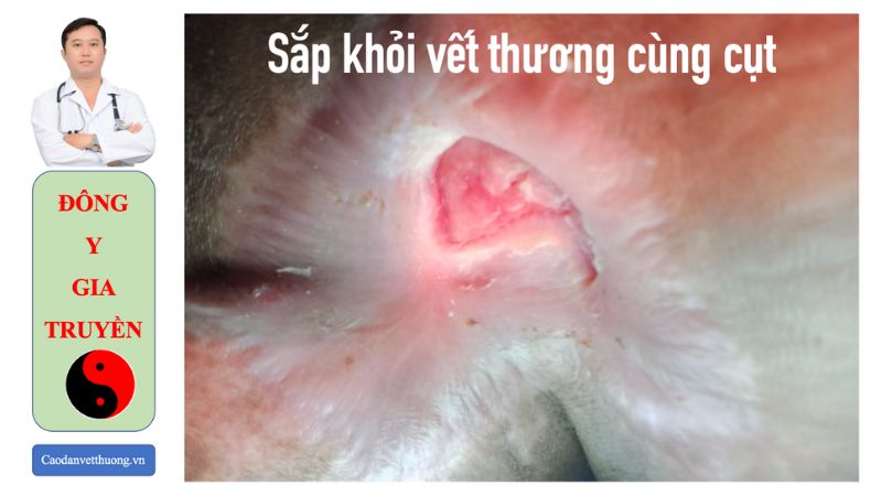 Hình ảnh vết thương bị nhiễm trùng