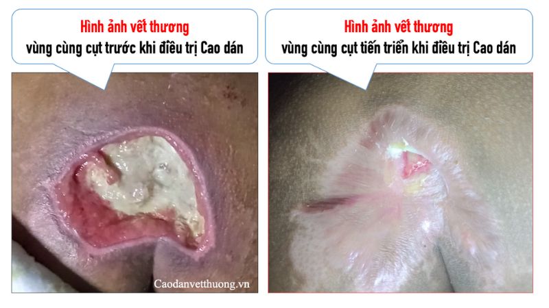 Hình ảnh vết thương bị nhiễm trùng