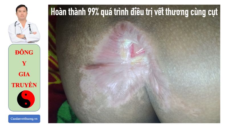 Hình ảnh vết thương bị nhiễm trùng