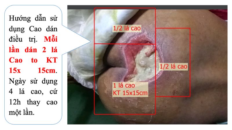 Hình ảnh vết thương bị nhiễm trùng