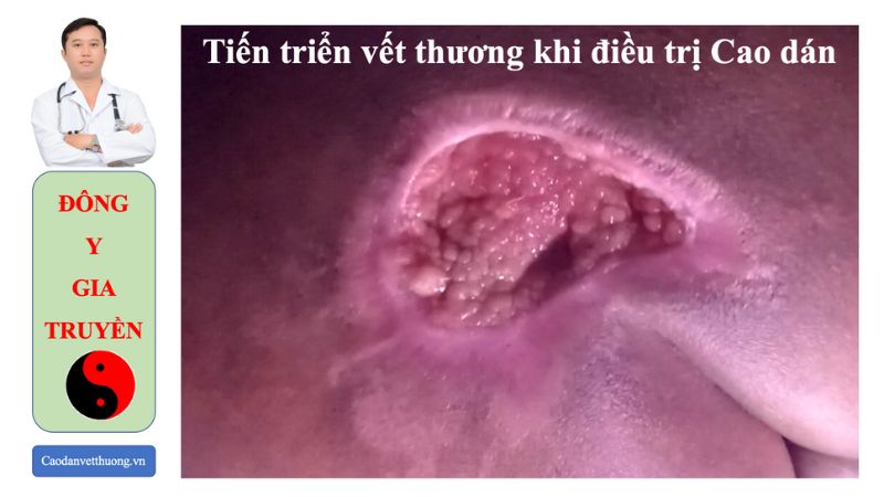 Hình ảnh vết thương bị nhiễm trùng