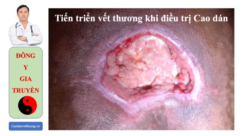 Hình ảnh vết thương bị nhiễm trùng