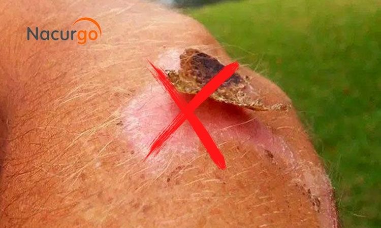 Không may bị trầy xước da nên làm gì cho nhanh khỏi?